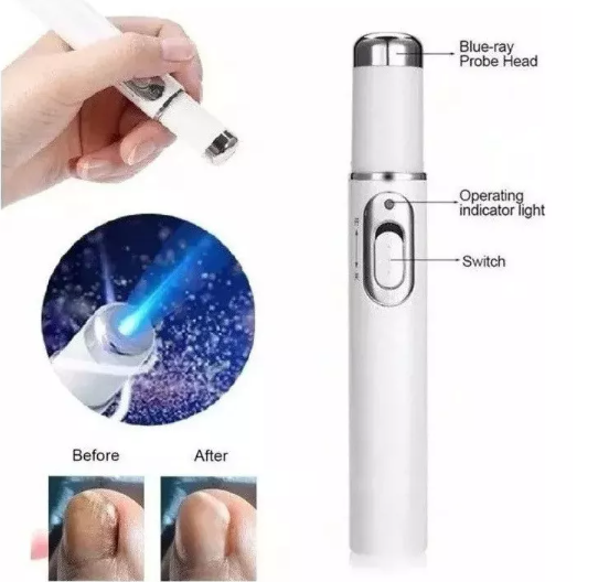 Lápiz Laser Azul para hongos en las uñas