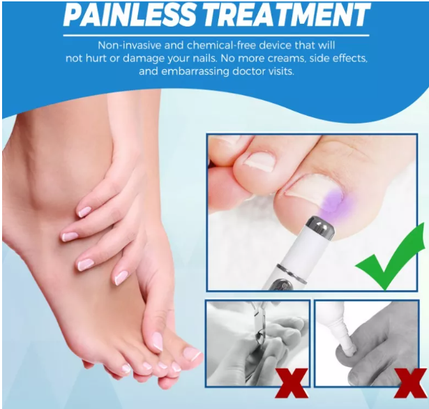 Lápiz Laser Azul para hongos en las uñas