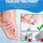 Lápiz Laser Azul para hongos en las uñas