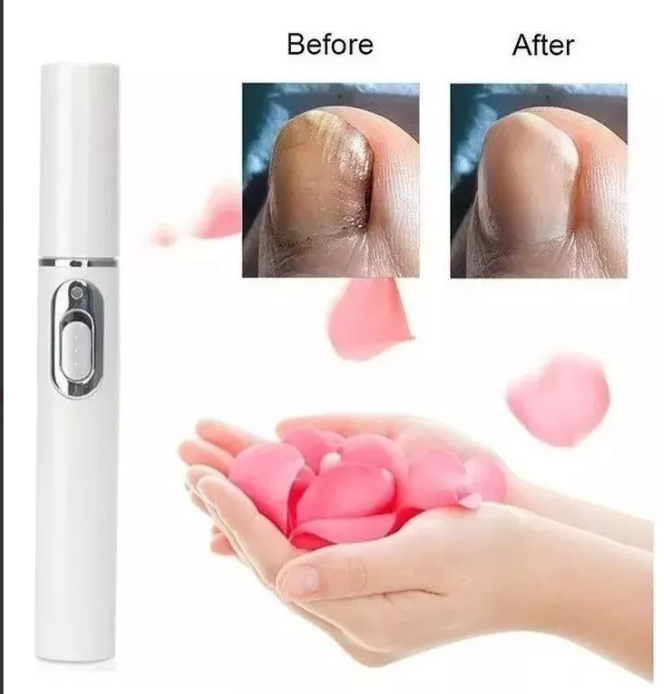 Lápiz Laser Azul para hongos en las uñas