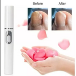 Lápiz Laser Azul para hongos en las uñas